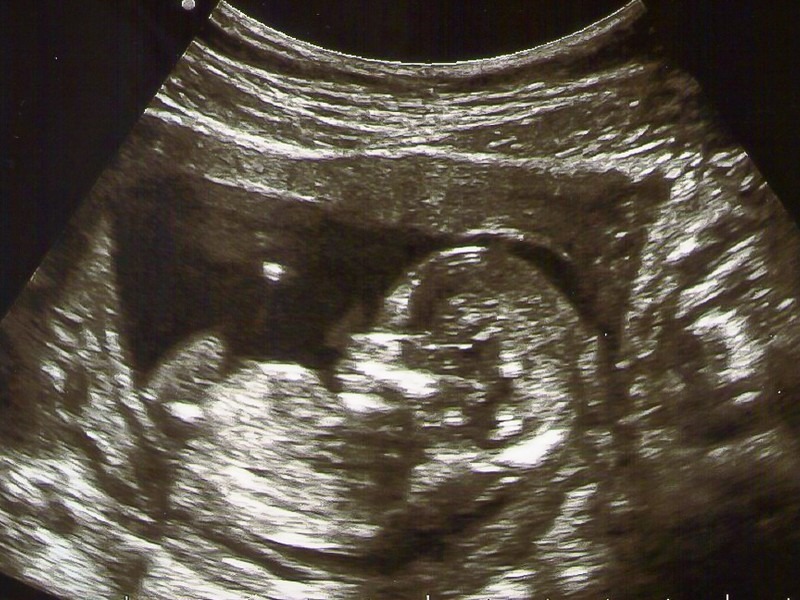 Ultrasound: Pregnant in Korea