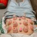 cupping therapy, or buhang (부항), traditional medicine