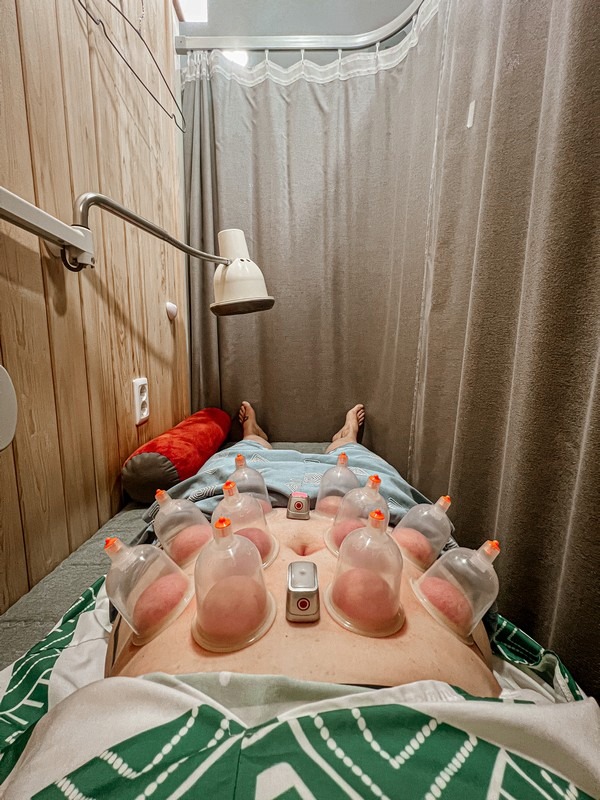 cupping therapy, or buhang (부항), traditional medicine