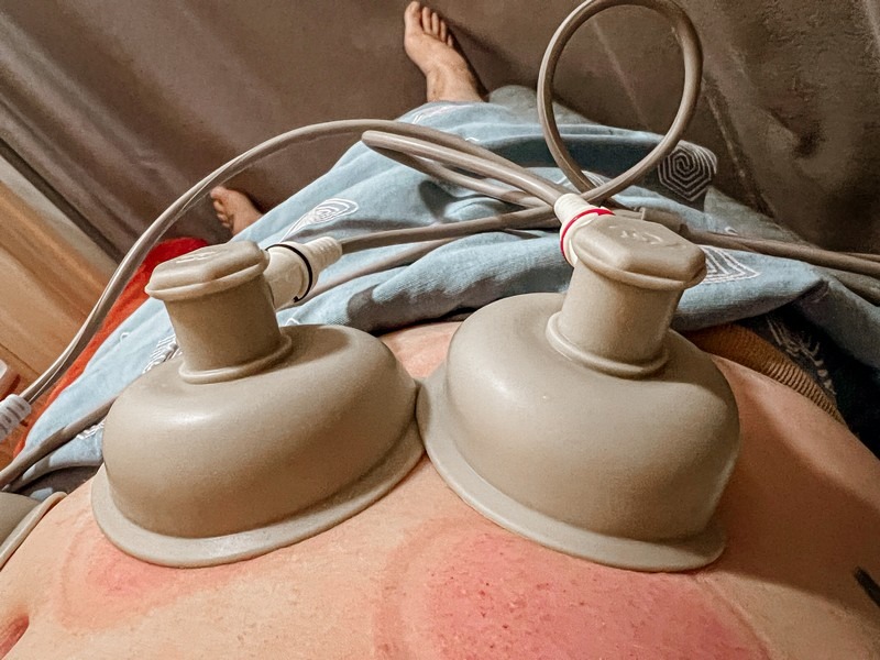 cupping therapy, or buhang (부항), traditional medicine