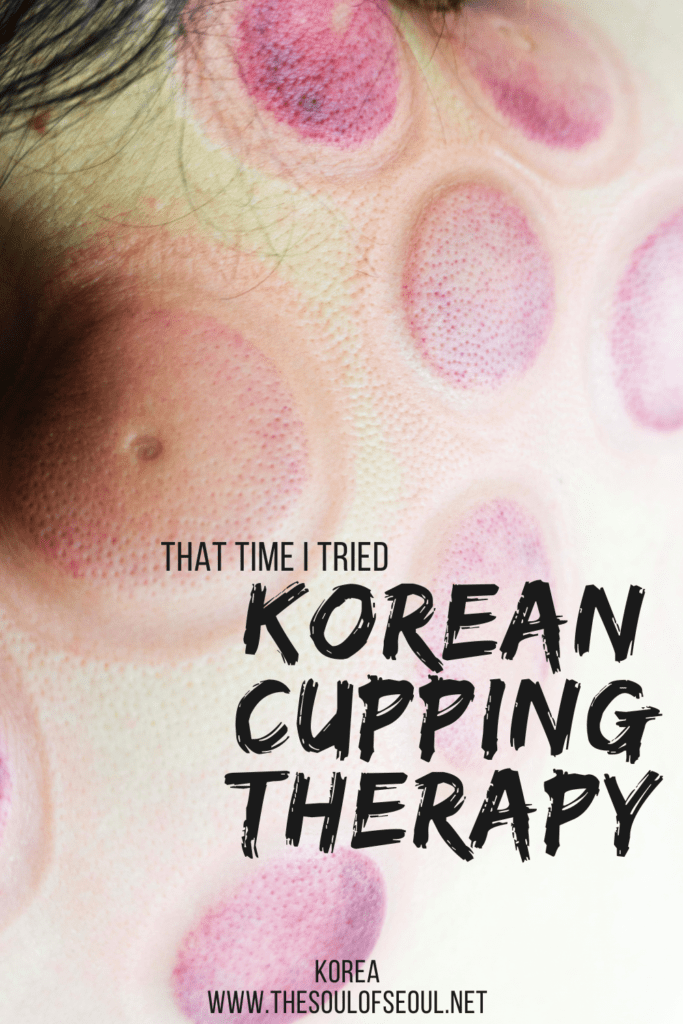 That Time I Got Korean Cupping Therapy: What Is It and My Honest Opinion: Korean cupping therapy, called buhang (부항), or the thing that makes those red circles on peoples' backs is a traditional practice and here's what to know about it.