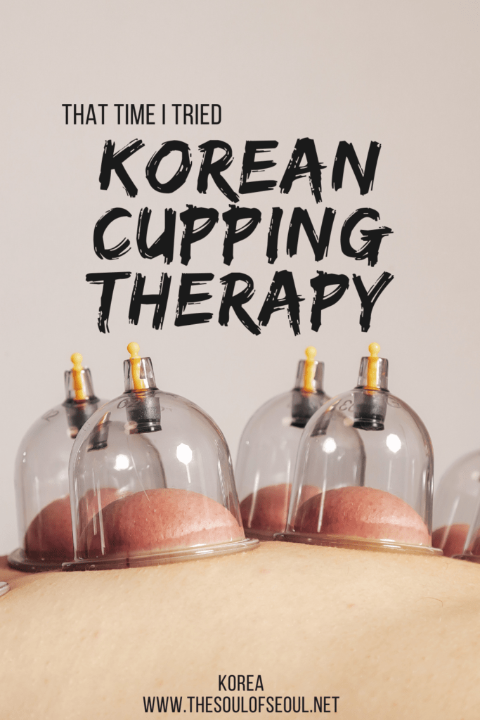 That Time I Got Korean Cupping Therapy: What Is It and My Honest Opinion: Korean cupping therapy, called buhang (부항), or the thing that makes those red circles on peoples' backs is a traditional practice and here's what to know about it.