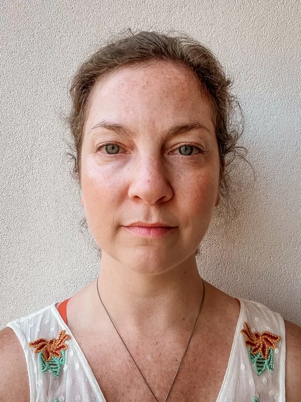 AB Plastic Surgery Clinic, plastic surgery in Seoul, Gangnam, Seoul, Korea; Before