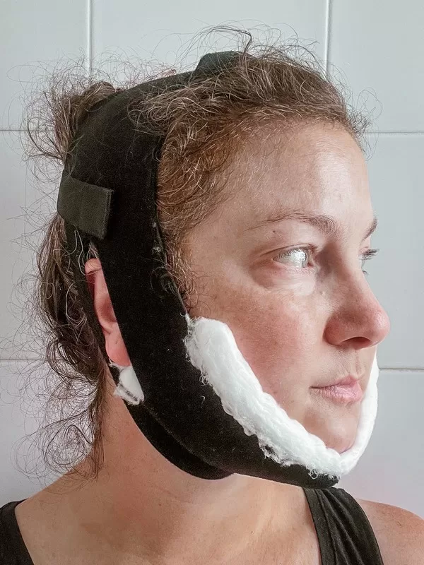 AB Plastic Surgery Clinic, plastic surgery in Seoul, Gangnam, Seoul, Korea; Day 2 post op