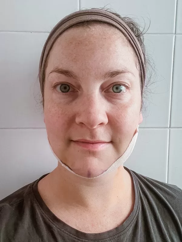 AB Plastic Surgery Clinic, plastic surgery in Seoul, Gangnam, Seoul, Korea; Day 4 post op