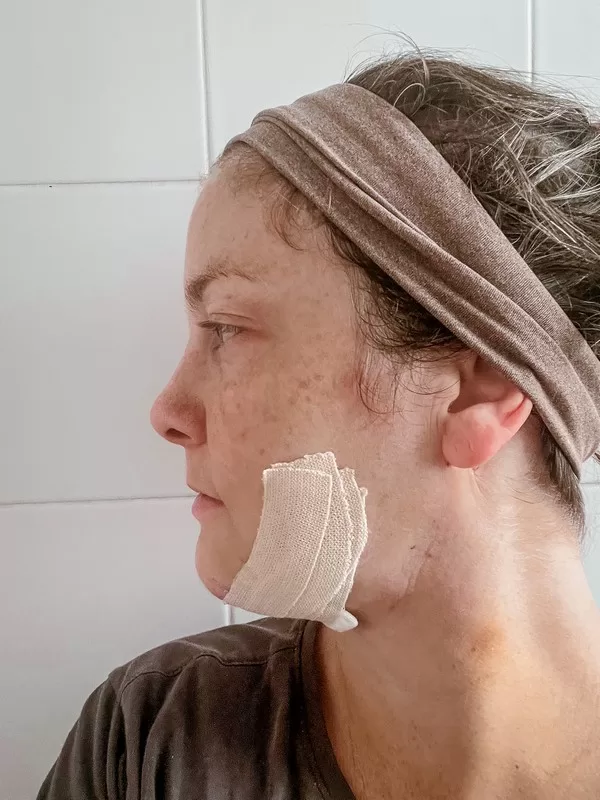 AB Plastic Surgery Clinic, plastic surgery in Seoul, Gangnam, Seoul, Korea; Day 4 post op