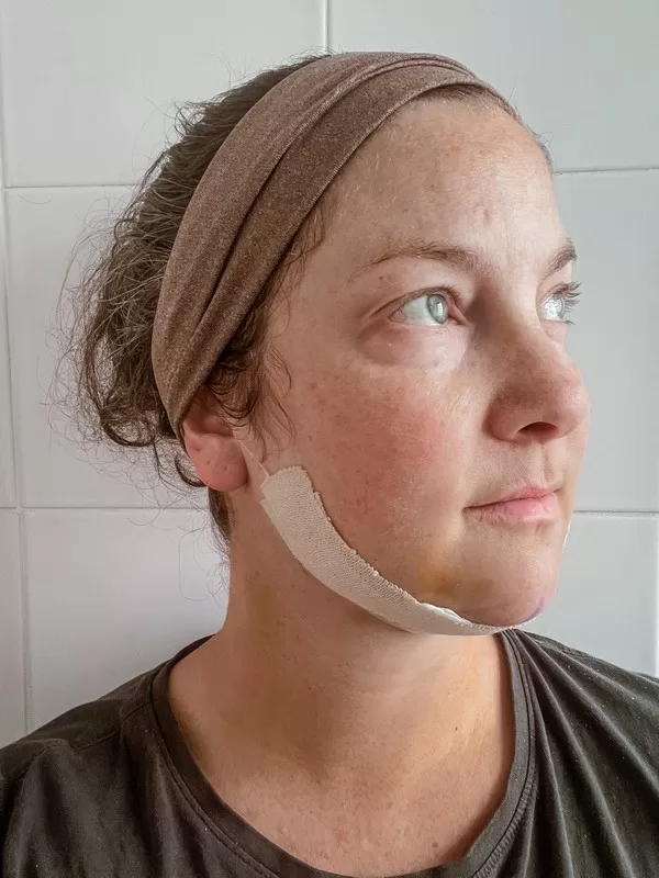 AB Plastic Surgery Clinic, plastic surgery in Seoul, Gangnam, Seoul, Korea; Day 4 post op