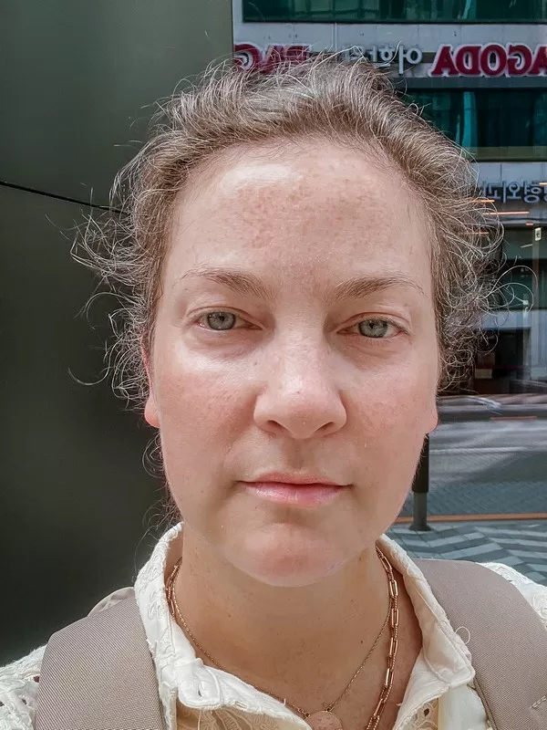 AB Plastic Surgery Clinic, plastic surgery in Seoul, Gangnam, Seoul, Korea; Day 7 post op