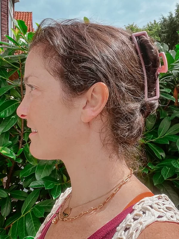 AB Plastic Surgery Clinic, plastic surgery in Seoul, Gangnam, Seoul, Korea; Week 2 post op