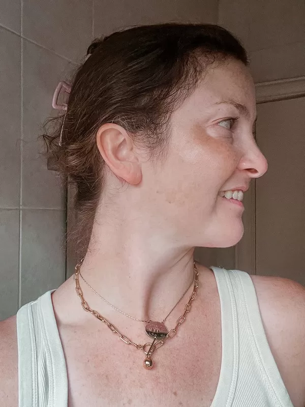 AB Plastic Surgery Clinic, plastic surgery in Seoul, Gangnam, Seoul, Korea; Week 3 post op