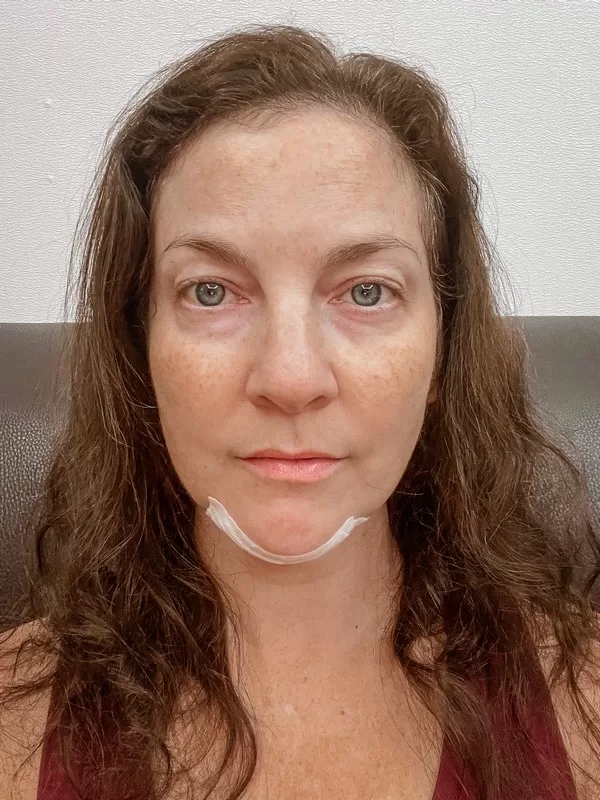 AB Plastic Surgery Clinic, plastic surgery in Seoul, Gangnam, Seoul, Korea; Week 6 post op