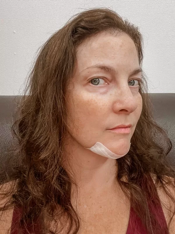 AB Plastic Surgery Clinic, plastic surgery in Seoul, Gangnam, Seoul, Korea; Week 6 post op