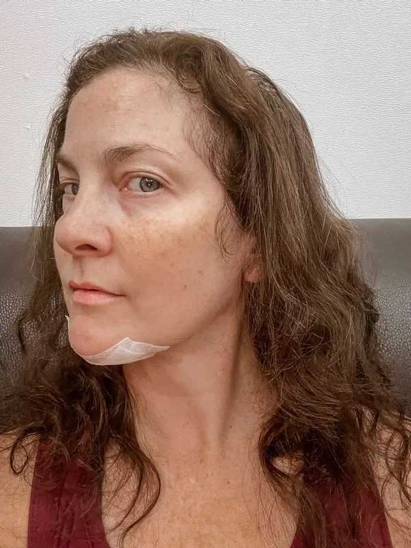 AB Plastic Surgery Clinic, plastic surgery in Seoul, Gangnam, Seoul, Korea; Week 6 post op