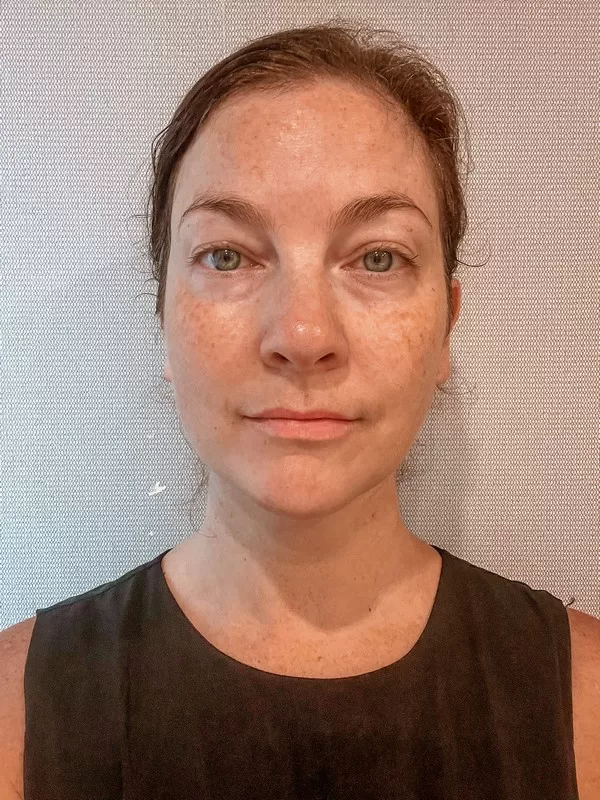 AB Plastic Surgery Clinic, plastic surgery in Seoul, Gangnam, Seoul, Korea; Week 8 post op