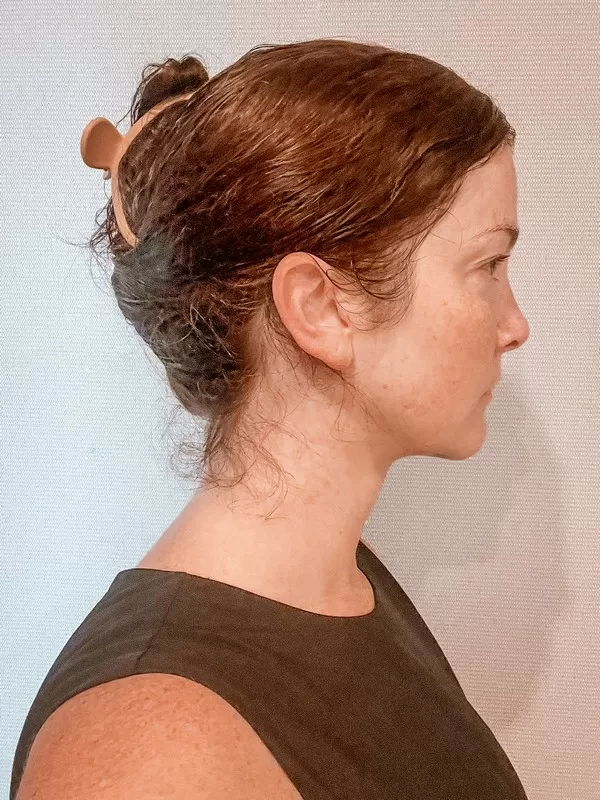 AB Plastic Surgery Clinic, plastic surgery in Seoul, Gangnam, Seoul, Korea; Week 8 post op