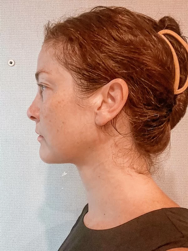 AB Plastic Surgery Clinic, plastic surgery in Seoul, Gangnam, Seoul, Korea; Week 8 post op